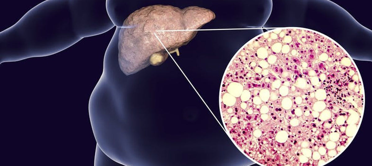 EXPERTS PREDICT:  Fatty Liver Disease will affect 90 million people in 2017